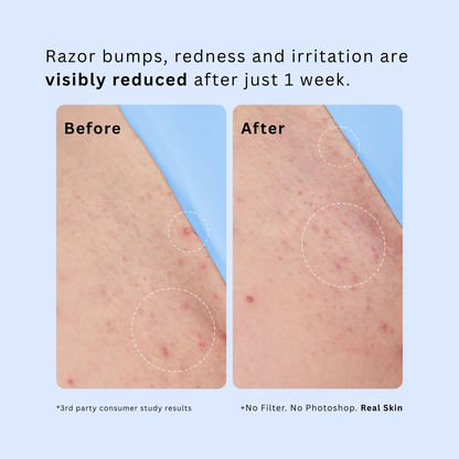 Novara: Smoothing & Ingrown Hair Treatment